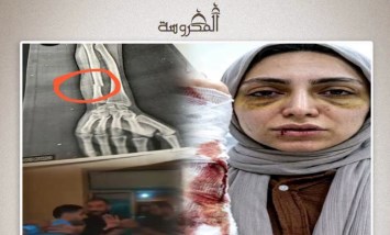 «دخلت تعالج مريضة خرجت لـ غرفة العمليات».. تفاصيل صادمة في واقعة الاعتداء على طبيبة أسنان بشبرا الخيمة